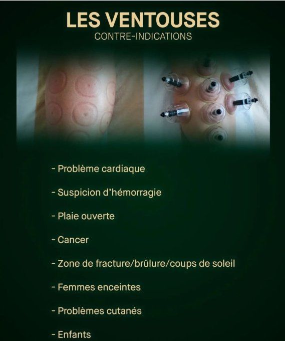 Massage Soin aux Ventouses ( Cupping Thérapie ) 50-60 min.