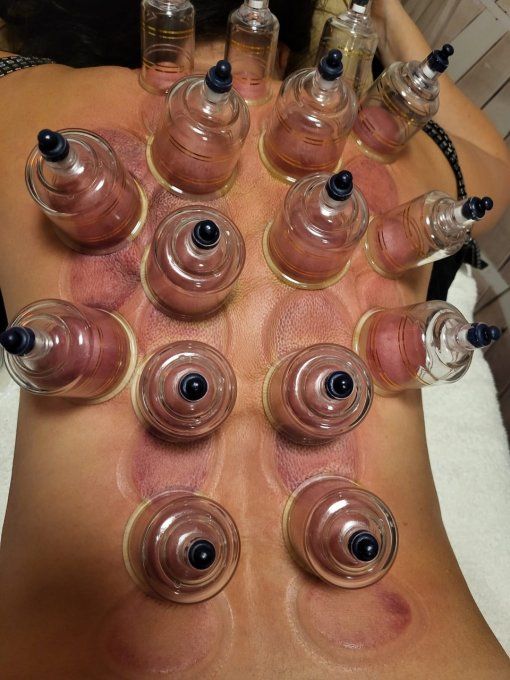 Massage Soin aux Ventouses ( Cupping Thérapie ) 50-60 min.