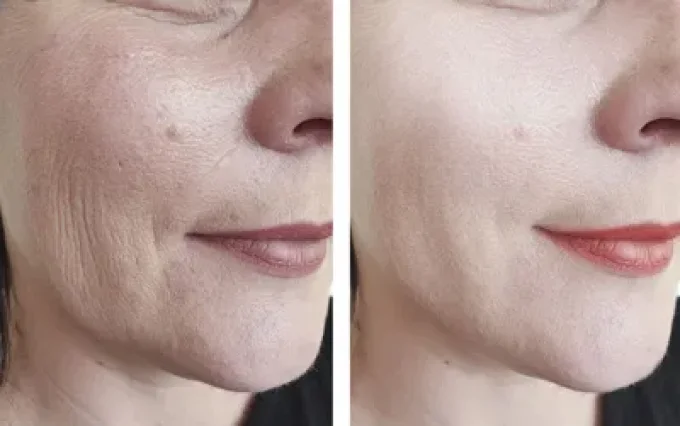 Rajeunissement du Visage  - Lifting Naturel 